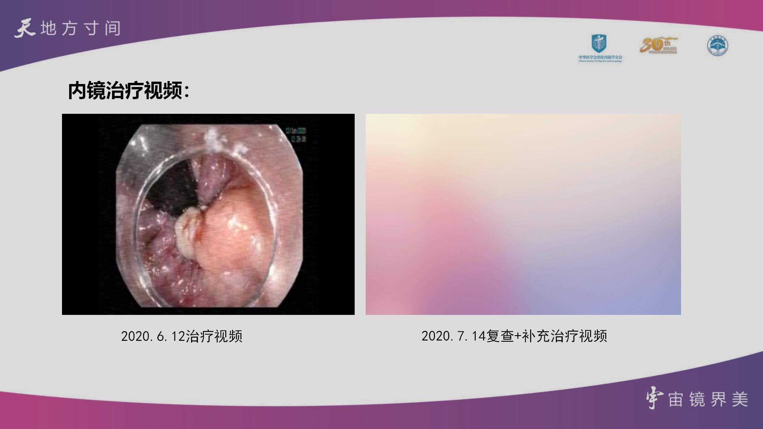 天宇长安杯内镜下内痔硬化治疗病例大赛-朱珂 阜阳二院_14.jpg